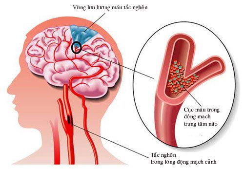 ĐIỀU TRỊ TIÊU SỢI HUYẾT CHO BỆNH NHÂN NHỒI MÁU NÃO